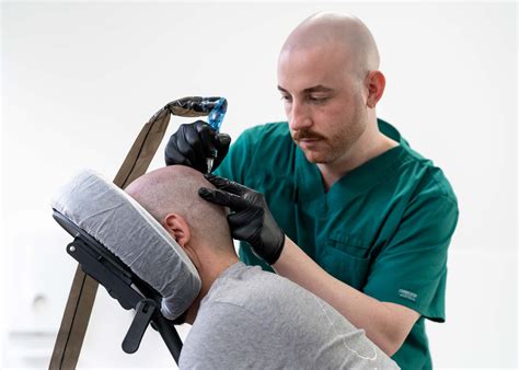 smp bugil|Best Scalp Micropigmentation 